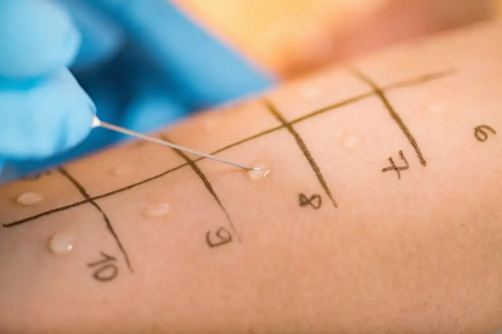 This is an image of an allergy test injection.